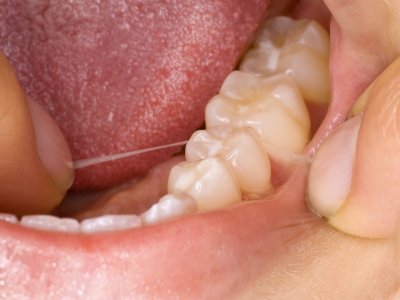 Prophylaxe und Therapie von Zahnfleischerkrankungen